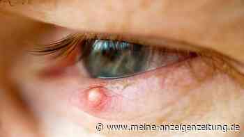 Gerstenkorn behandeln: Was hilft bei Entzündungen am Auge?