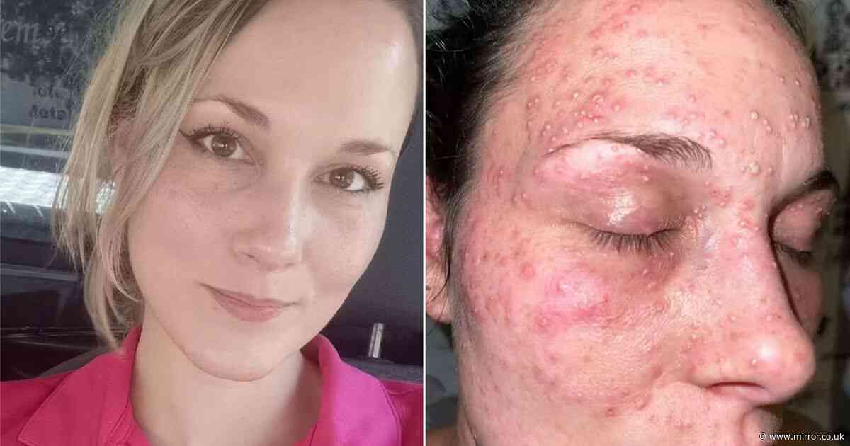 Mum's face covered in blistered bites after cops handcuff her 'face down in pile of fire ants'