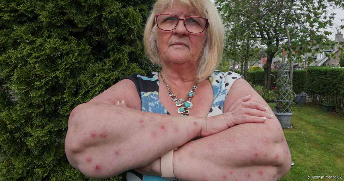 Pensioner left covered in infected sores after all-inclusive 'holiday from hell'