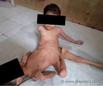 Conjoined twins in Indonesia born fused together like a 'spider' in ultra rare case