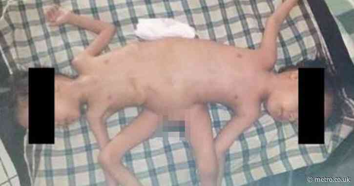 Conjoined twins born fused together like a ‘spider’ in one in 2,000,000 case