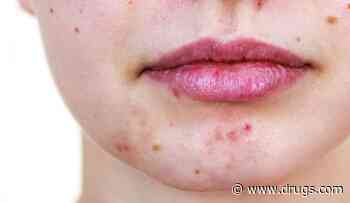 Could a Low-Cal Keto Diet Help Ease Acne?