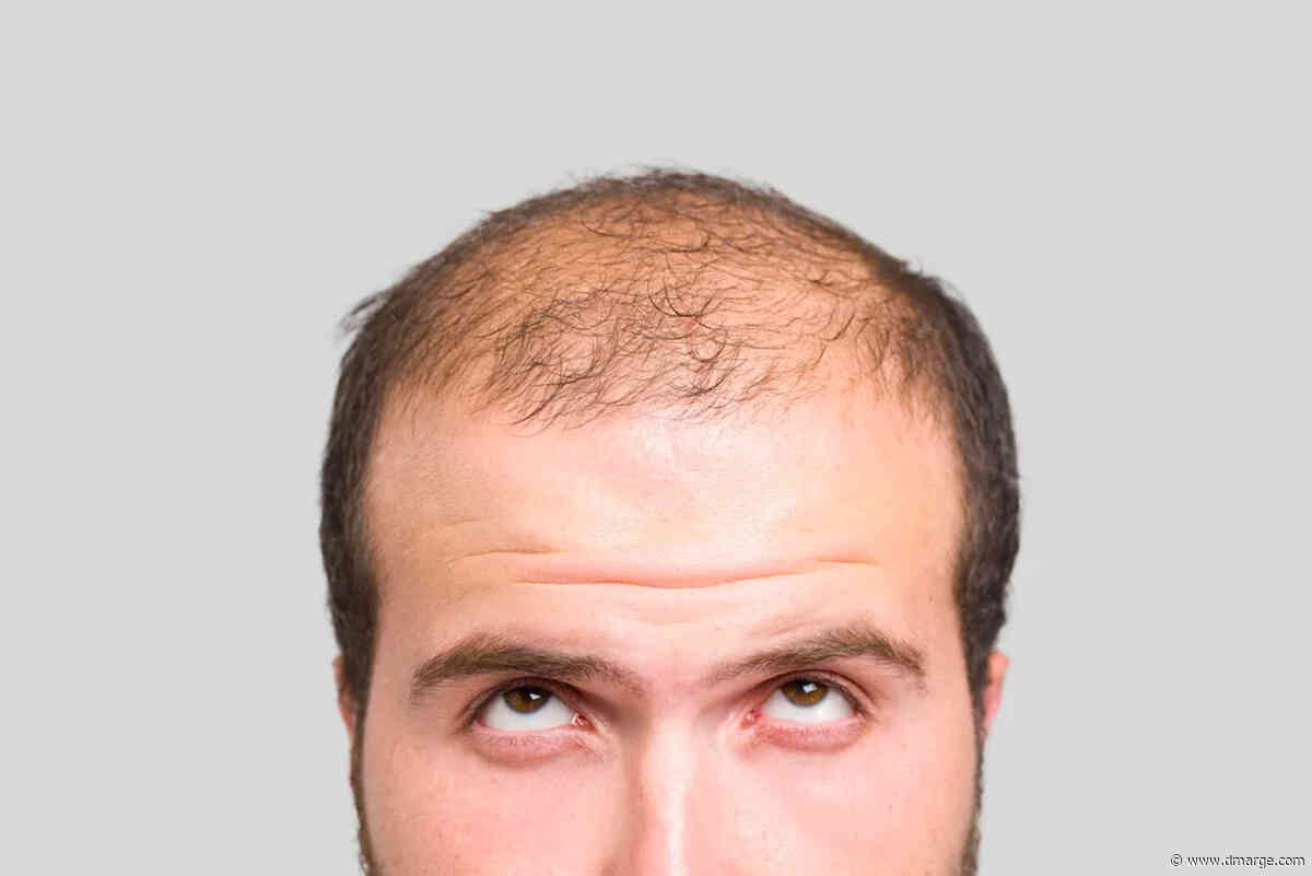 Scientists Reveal The Only Guaranteed Way To Never Go Bald, But You Won’t Like It