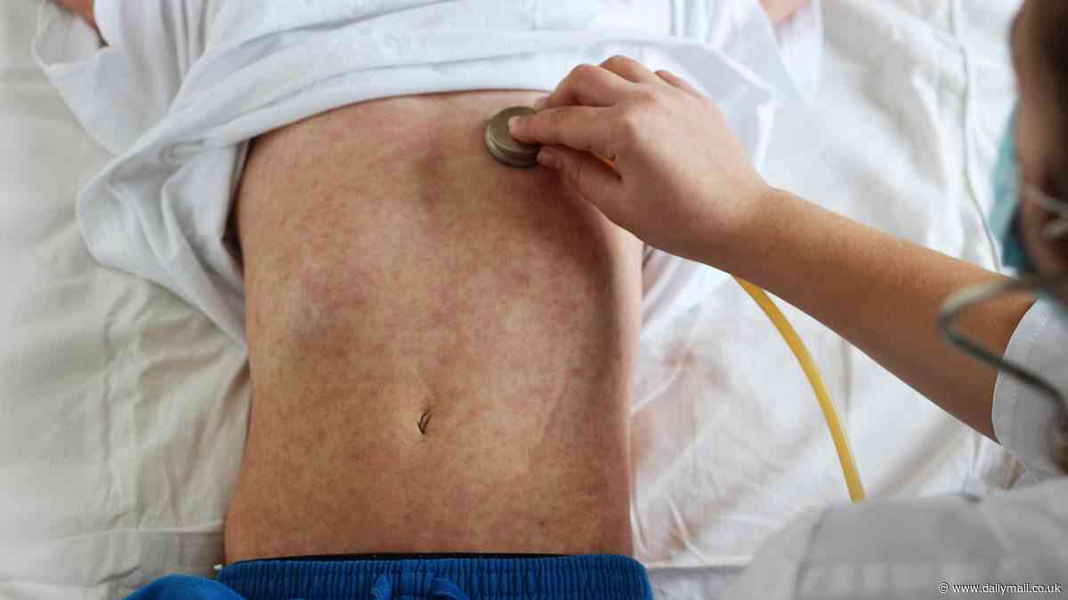 Staggering 84 percent of measles cases in major Chicago outbreak linked to Venezuelan migrants, CDC report shows