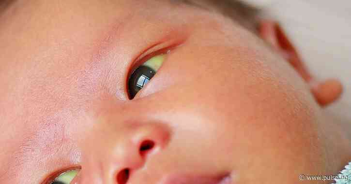 Putting pawpaw water, breast milk in baby's eyes won't cure jaundice