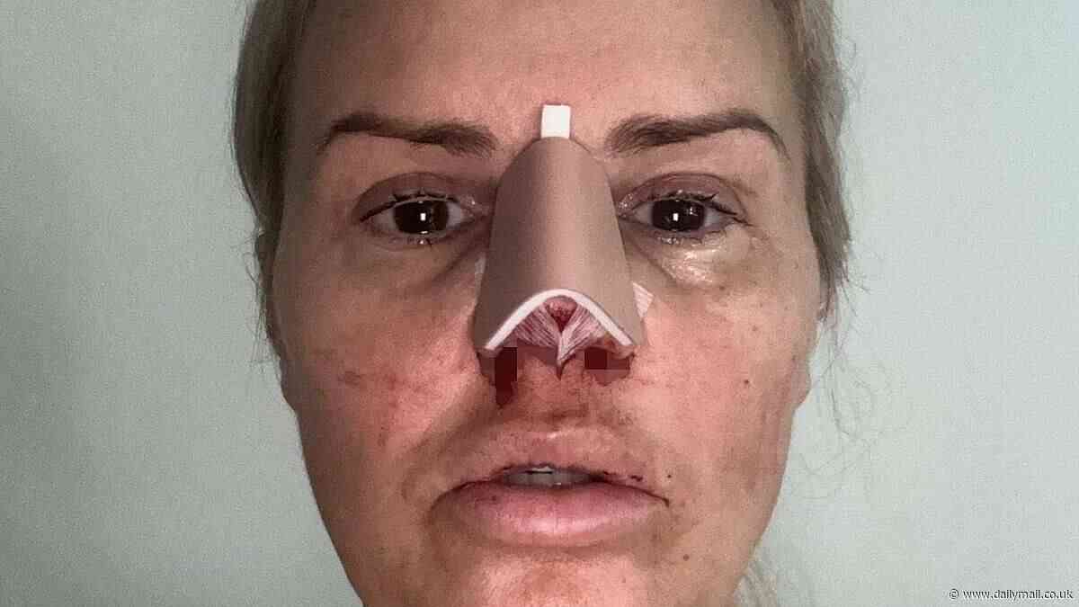 Kerry Katona admits she burst into tears after seeing her new nose because she was upset she 'doesn't look like her biological father anymore'