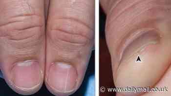 How a long white line on your finger nail could mean you're at a much higher risk of kidney CANCER