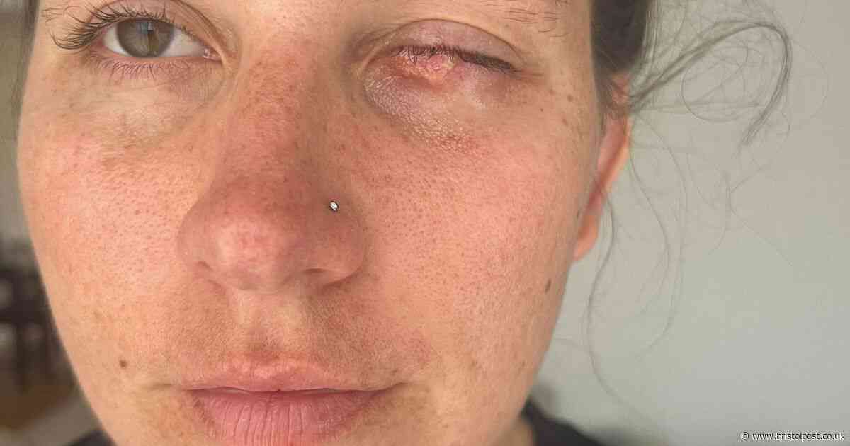 Mum's eye sewn shut after 'tiny spot' seen at lash appointment