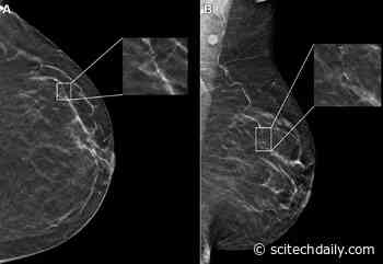 AI’s Breast Cancer Blind Spots Exposed by New Study