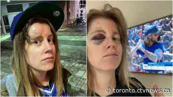 Blue Jays fan struck by 110 m.p.h foul ball, offered tickets and custom baseball card