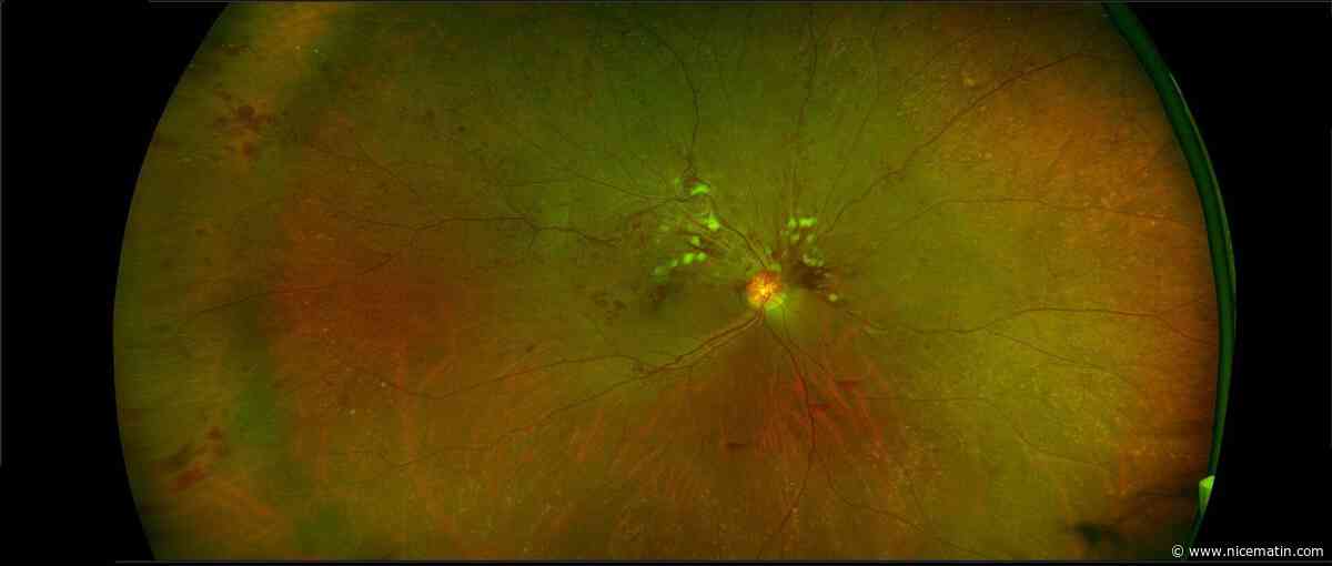 La vue baisse brutalement et devient floue: tout ce qu'il faut savoir sur la thrombose de l'œil