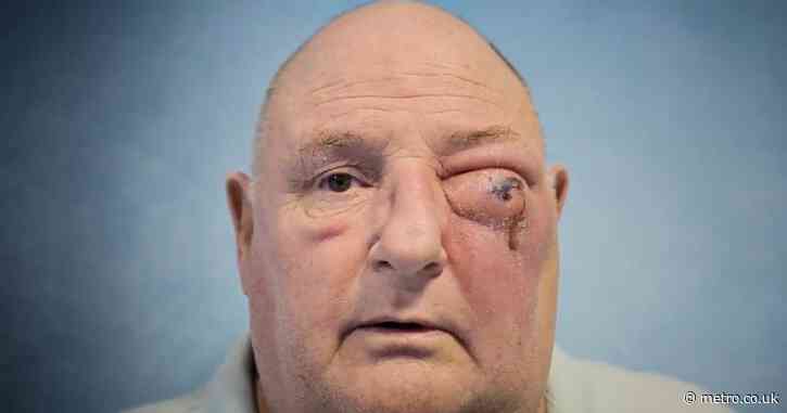 Man has ‘life-saving’ surgery after flesh-eating bacteria from tooth infection leaves his eye full of pus