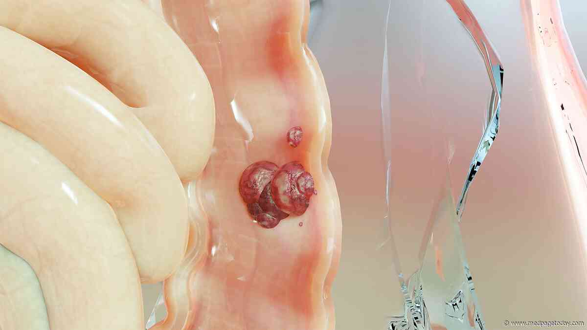 Blood in Stool, Abdominal Pain Top Red Flags for Early-Onset Colorectal Cancer