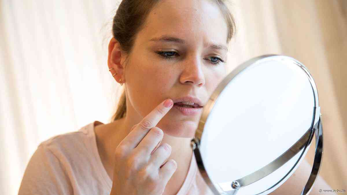Warentest gegen Bläschen: Kein Lippenherpes-Mittel bringt schnelle Heilung