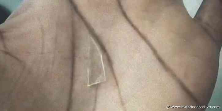 Así era el cristal incrustado en el pie de Iñaki Williams