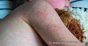 Measles cases confirmed in Bristol as England sees infections soar
