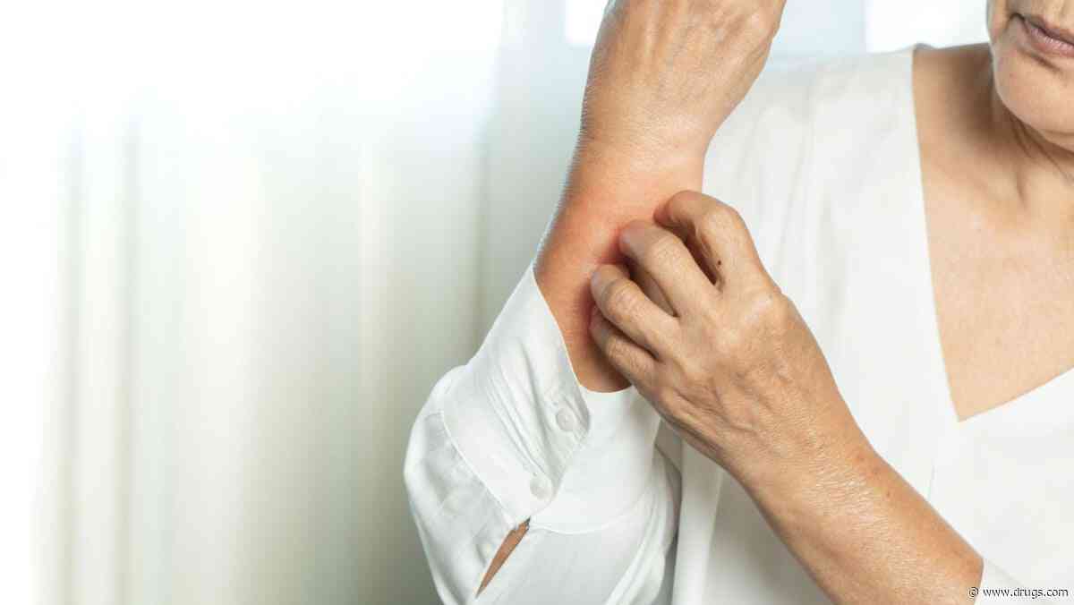 Antihypertensives Linked to Eczematous Dermatitis in Seniors