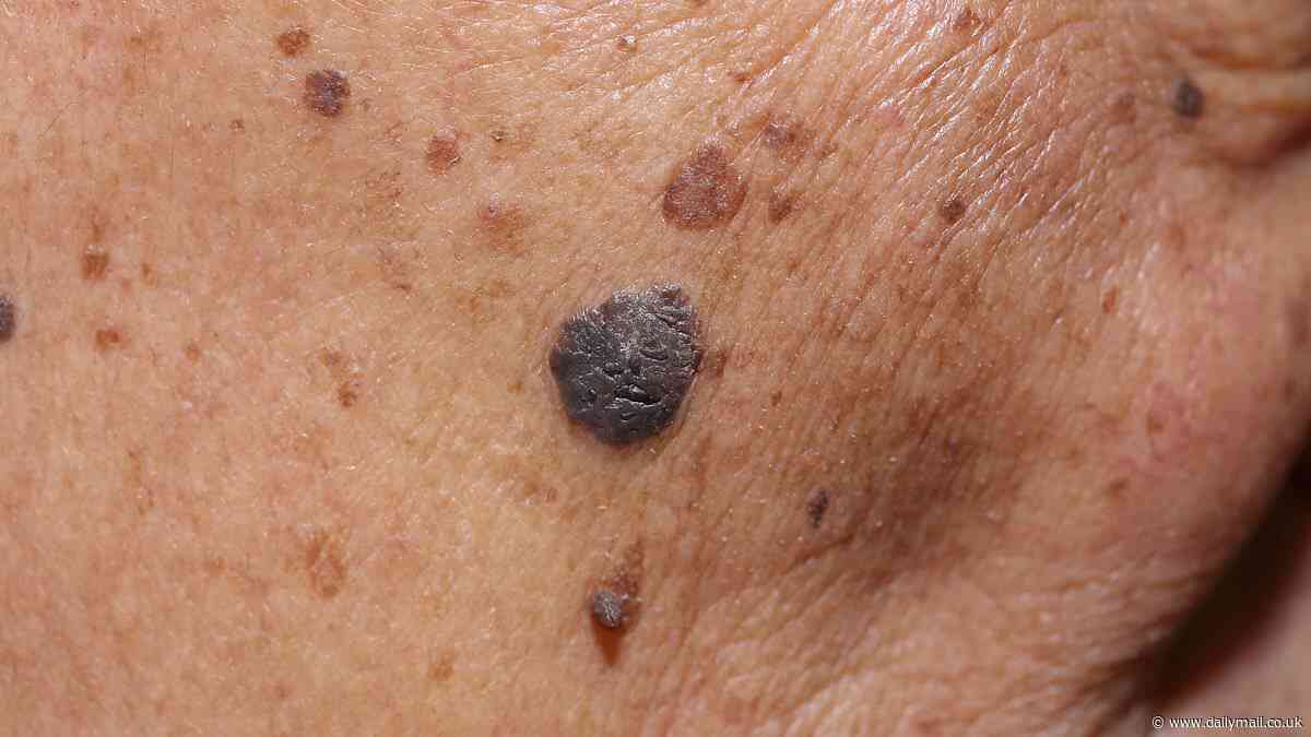 Six early warning signs of skin cancer revealed - and when to worry about patches on the GENITALS - as charities warn over 20,000 cases are expected this year