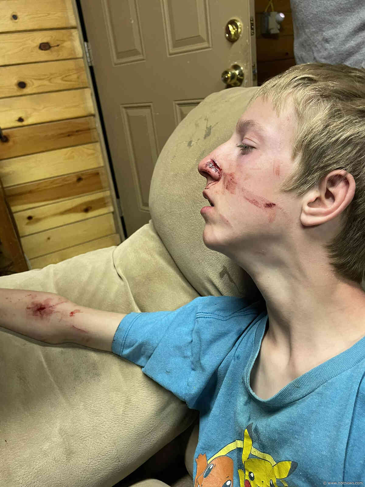 Arizona teen escapes bear attack with nasty scratches