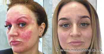 Mum finds 'miracle' acne cure after six years of 'face on fire'
