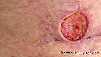 Most Chronic Wounds Not Managed by Dermatologists