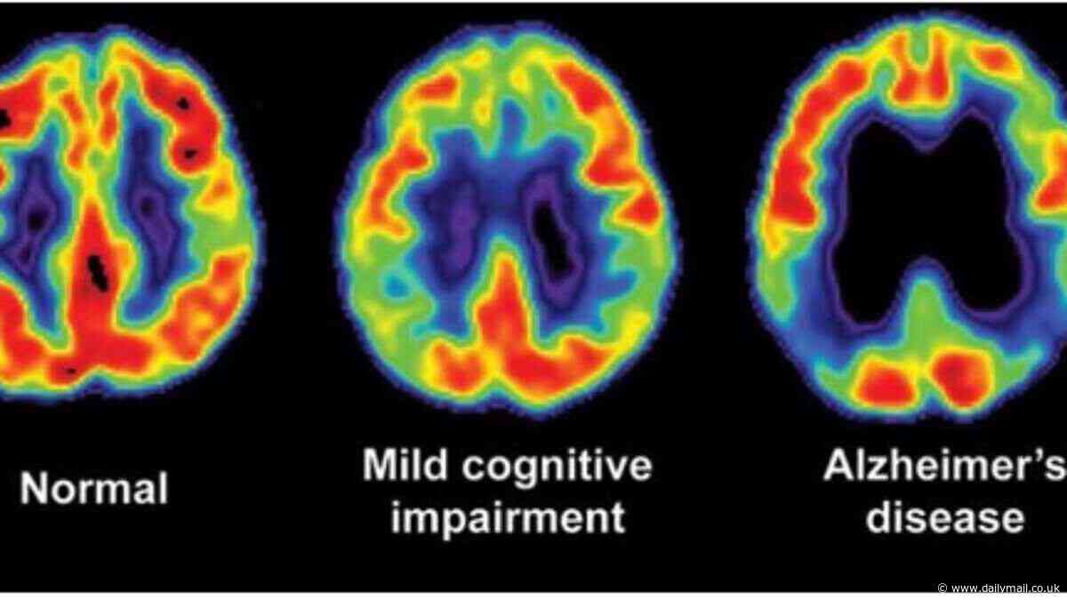 How studying these 12 Alzheimer's patients with NO symptoms could help doctors cure the memory-robbing disease