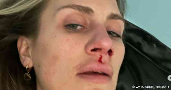 Paura per Nikita Pelizon, pubblica un post dall’ospedale con il volto tumefatto: ecco cos’è accaduto