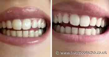 Shoppers say £1.50 teeth-whitening solution ‘transformed smile’ in as little as 30 minutes