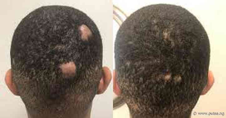 How to regrow bald spots on your hair naturally