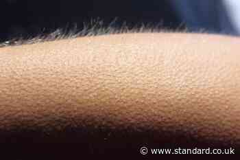 You may get goosebumps far more often than you think – study