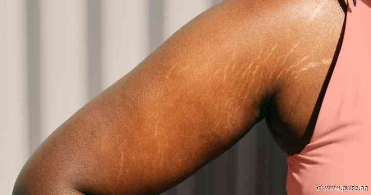 How to get rid of stretch marks scientifically
