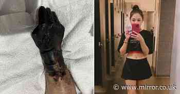 Beautician loses hands and legs after freak condition turns them black