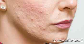UK Poll Shows 40% of adults avoid social events due to acne and skin blemishes