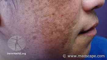 Newer Therapies Target Different Melasma Components