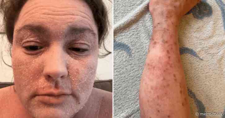 My skin condition cost me my job and social life – but I have now found a community