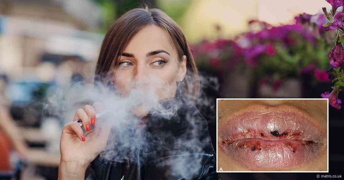 How one year of vaping left a woman’s mouth covered in ulcers so bad she couldn’t eat