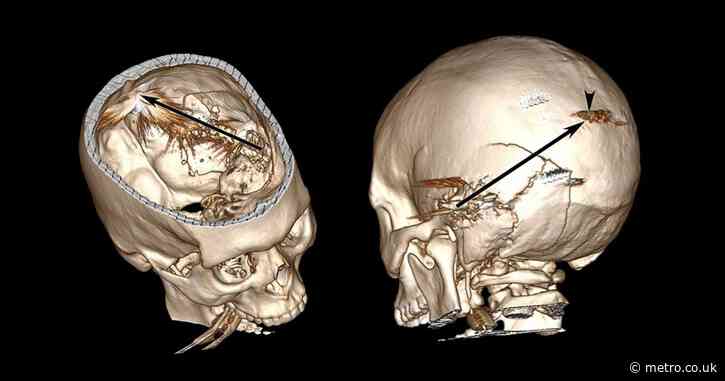 Man takes bullet to the brain and survives after 97% chance of dying