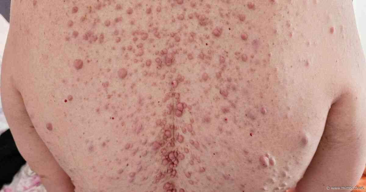 Mum has thousands of tumours all over her body - both inside and out her skin