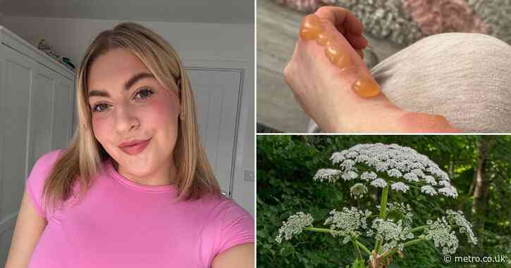 Woman, 20, suffers third-degree burns from ‘Britain’s most dangerous plant’