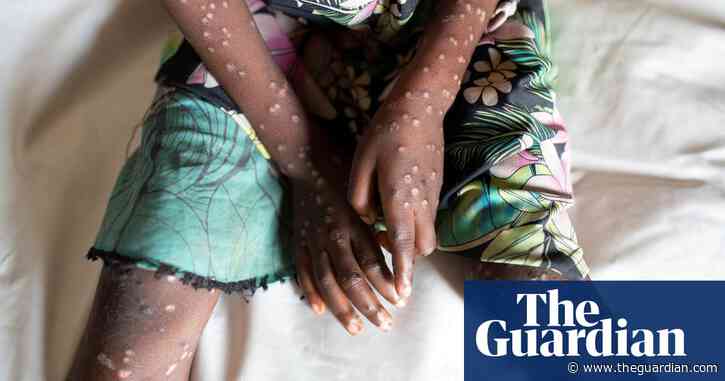 Warnings over lethal and contagious strain of mpox as children in DRC die