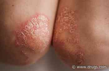 Psoriasis, With or Without Psoriatic Arthritis, Associated With Fatigue