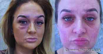 'I looked like I'd been beaten after make-up reaction, it lasted for months'