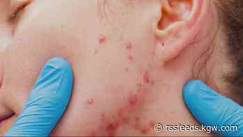 6 measles cases confirmed in Marion County
