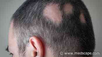 FDA Approves JAK Inhibitor for Alopecia Areata