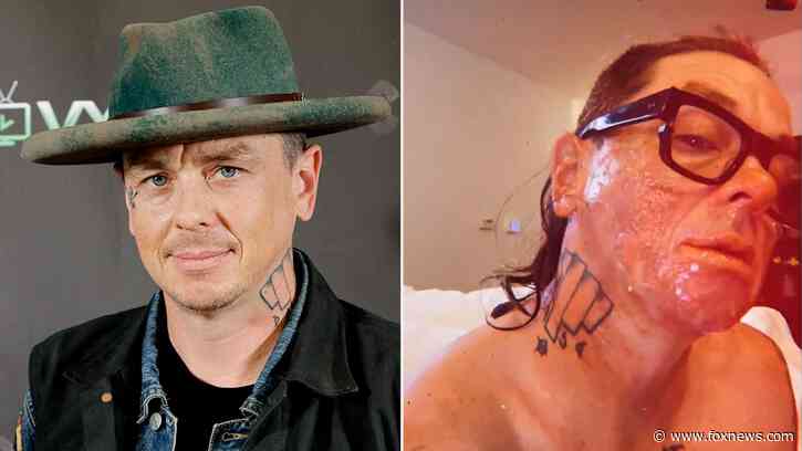 Slipknot’s Sid Wilson describes gruesome injuries after bonfire explosion: ‘My face is basically melted’