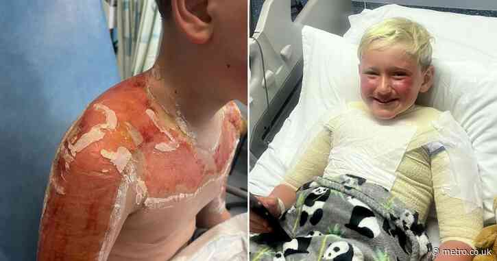 Boy gets so badly sunburned he needed surgery after using ‘expired’ suncream