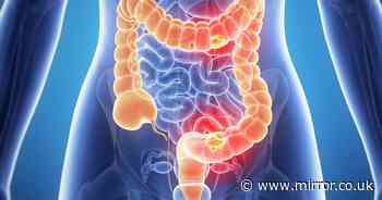 'Bowel cancer trial sees all patients disease-free'