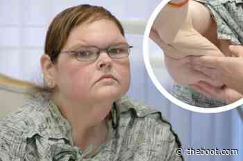 ‘1000-Lb. Sisters’ Tammy Slaton Ready for Loose Skin Surgery