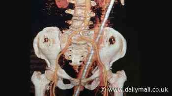 Doctors remove 2ft rusty metal rod from woman's backside after it impaled her when she slipped and fell in her backyard