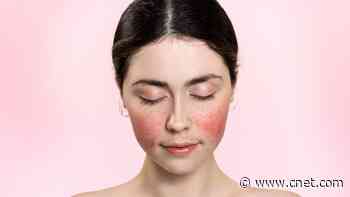 How to Treat Rosacea: Skin Care Tips